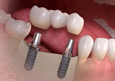 Dental Implant