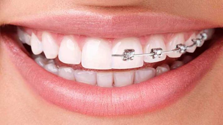 Orthodontic Treatment